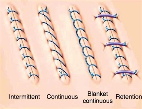 Sutures .